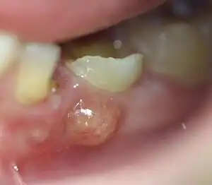 Dental abscess commonly seen in people with underdeveloped tooth enamel caused by TDO.