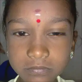 Saddle nose