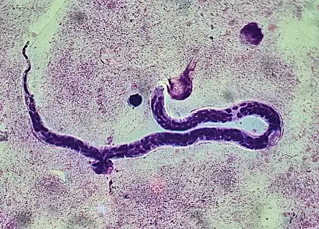 Whole blood with microfilaria worm, giemsa stain