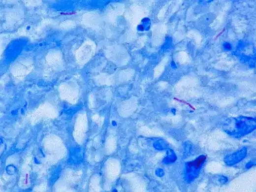 M. tuberculosis (stained red) in tissue (blue)