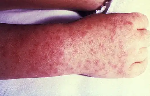 Right hand and wrist displaying the characteristic spotted rash of Rocky Mountain spotted fever