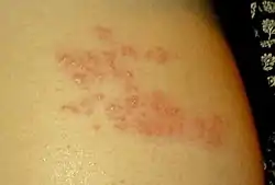Shingles - vesicular stage (cluster)