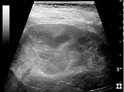 Kidney ultrasonograph of acute pyelonephritis with increased cortical echogenicity and blurred delineation of the upper pole.