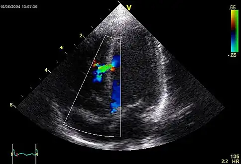 Ventricular septal defect via echocardiogram