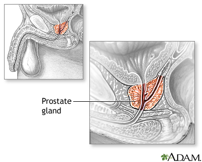 Transurethral Resection of the Prostate (TURP) - Series Transurethral Resection of the Prostate (TURP) - Series