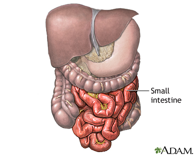 Meckel's diverticulectomy - normal anatomy Meckel's diverticulectomy - normal anatomy