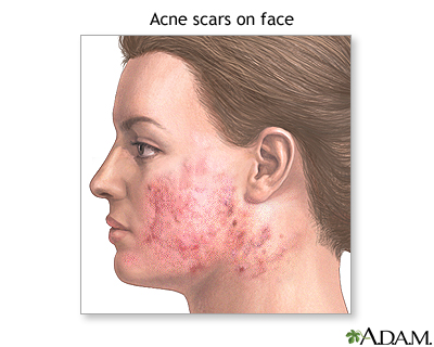 Skin smoothing surgery - series - Indication Skin smoothing surgery - series - Indication