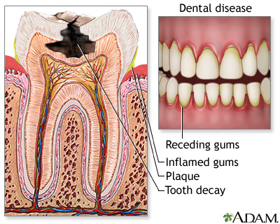 Gingivitis Gingivitis