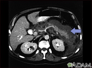 Pancreatitis, acute - CT scan Pancreatitis, acute - CT scan