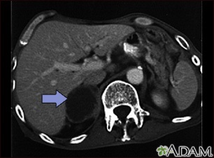 Adrenal metastases - CT scan Adrenal metastases - CT scan