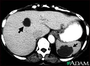 Liver and spleen cysts - CT scan Liver and spleen cysts - CT scan