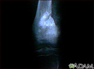 Osteogenic sarcoma - X-ray Osteogenic sarcoma - X-ray