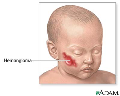 Hemangioma excision - series Hemangioma excision - series