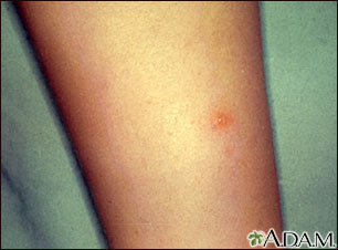 Chickenpox - lesion on the leg Chickenpox - lesion on the leg
