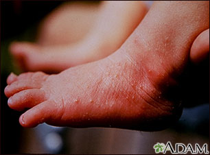 Erythema toxicum on the foot Erythema toxicum on the foot