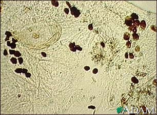 Scabies mite - photomicrograph of the stool