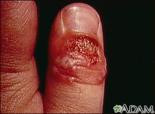 Herpetic whitlow on the thumb Herpetic whitlow on the thumb