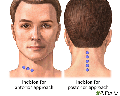 Incision Incision