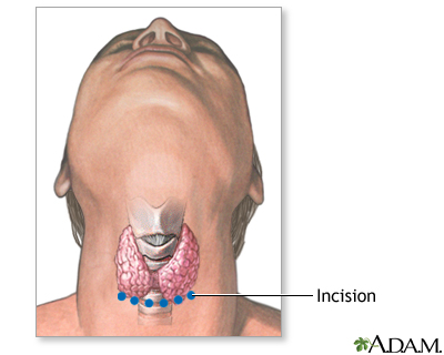 Incision Incision
