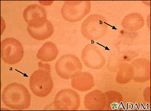 Malaria, photomicrograph of cellular parasites Malaria, photomicrograph of cellular parasites