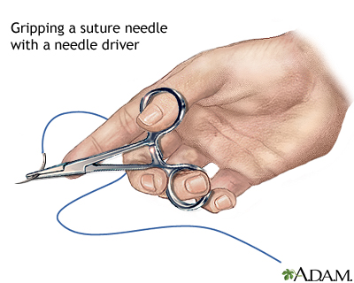 Sewing a wound closed Sewing a wound closed