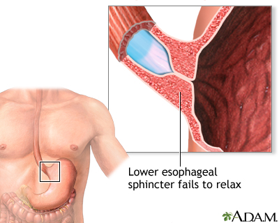 Indications Indications