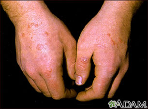 Erythema multiforme on the hands Erythema multiforme on the hands