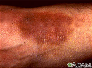 Lichen simplex chronicus on the ankle Lichen simplex chronicus on the ankle