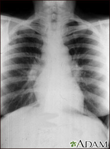Sarcoid, stage I - chest X-ray Sarcoid, stage I - chest X-ray