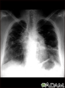 Sarcoid, stage IV - chest x-ray Sarcoid, stage IV - chest x-ray
