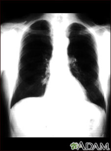 Lung nodule - front view chest X-ray Lung nodule - front view chest X-ray