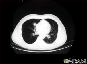 Lung nodule, right lower lung - CT scan Lung nodule, right lower lung - CT scan