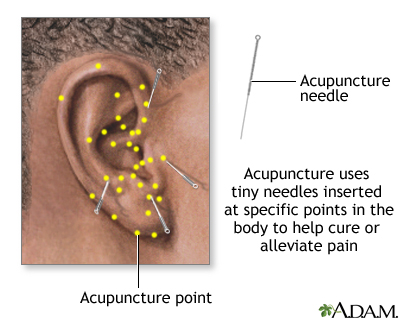 Acupuncture Acupuncture