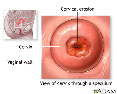 Cervical erosion Cervical erosion