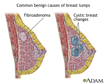 Causes of breast lumps Causes of breast lumps