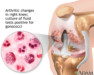 Gonoccocal arthritis Gonoccocal arthritis