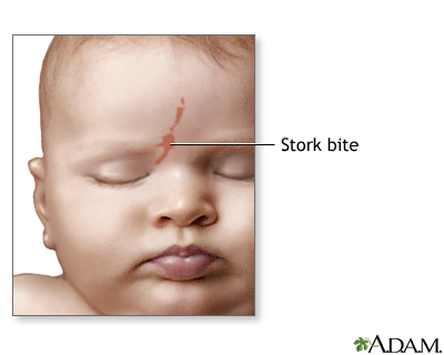 Stork bite Stork bite
