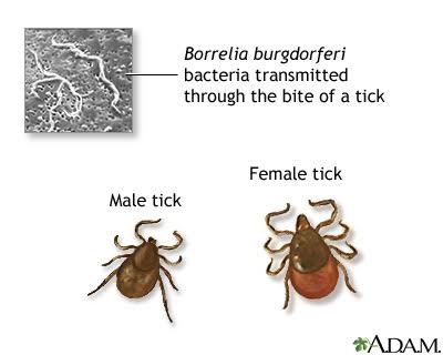 Tertiary Lyme disease Tertiary Lyme disease