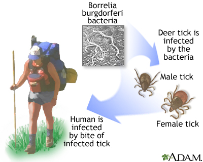 Lyme disease Lyme disease