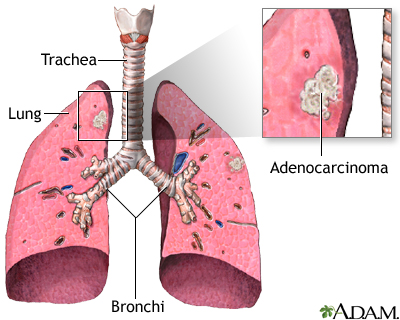 Adenocarcinoma Adenocarcinoma
