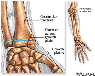 Fractures across a growth plate Fractures across a growth plate