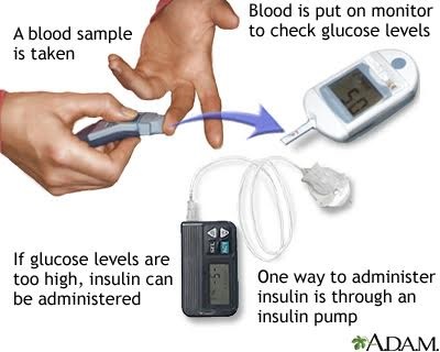 Glucose test Glucose test