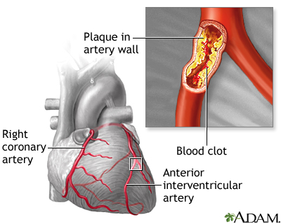 Atherosclerosis Atherosclerosis