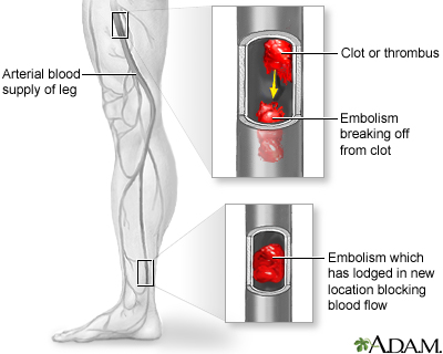 Arterial embolism