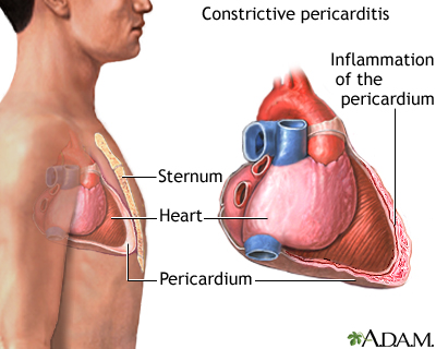 Constrictive pericarditis Constrictive pericarditis