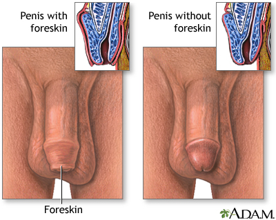 Penis - with and without foreskin Penis - with and without foreskin