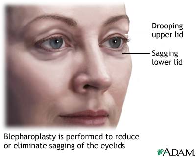 Blepharoplasty - series Blepharoplasty - series