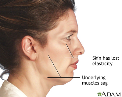 Facelift - series - Indications Facelift - series - Indications