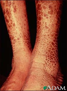 Ichthyosis, acquired - legs Ichthyosis, acquired - legs