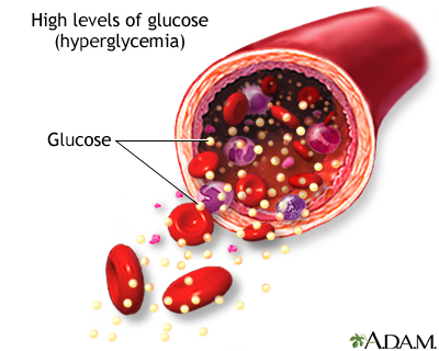 High blood sugar High blood sugar